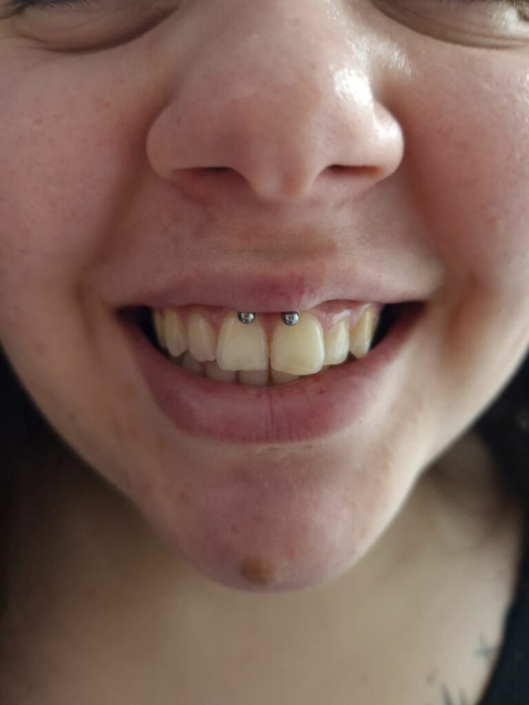 Piercing smiley au frein de la lèvre supérieure avec anneau à billes, réalisé par Oc Piercing au salon Jolie Piqûre à Arles